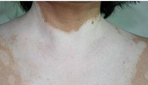 白癜风可以吃红瓜吗,适宜食用还是需谨慎？